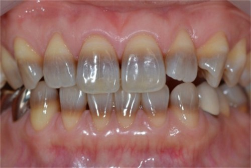 Teeth Whitening | Lindsten Family Dentistry